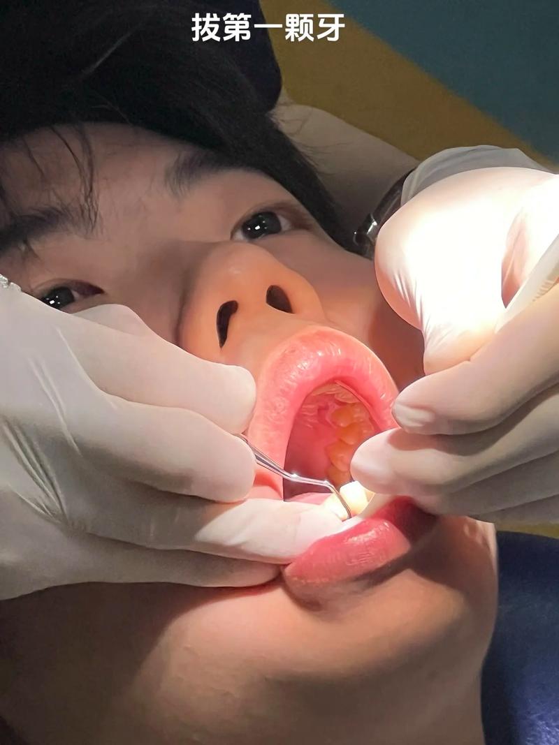 正畸拔牙后不疼是正常的吗?-图2 正畸拔牙后不疼是正常的吗?-图2