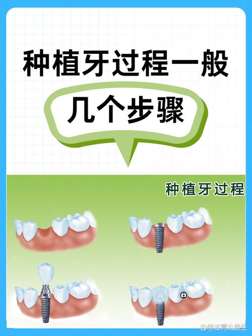 要种植全口牙怎么种-图1 要种植全口牙怎么种-图1