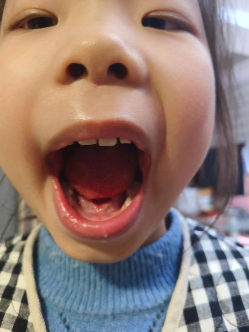 没门牙用哪种方法好-图2