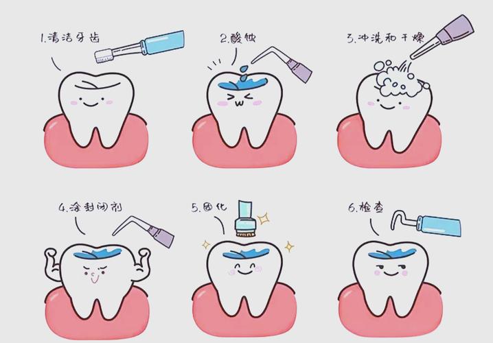 牙沟封闭有几种方法?常见封闭方式有哪些?-图1 牙沟封闭有几种方法?常见封闭方式有哪些?-图1