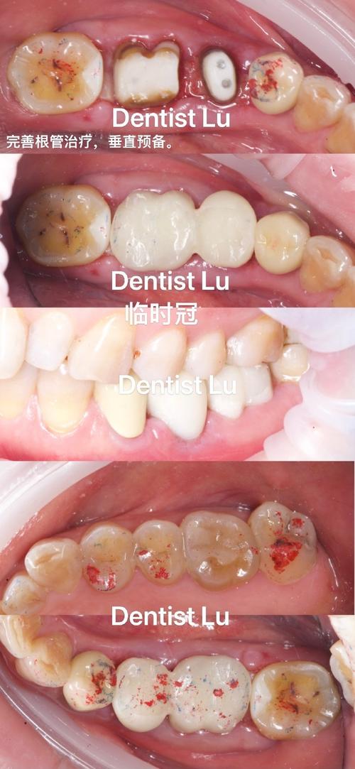 根管治疗后做牙冠正畸-图3