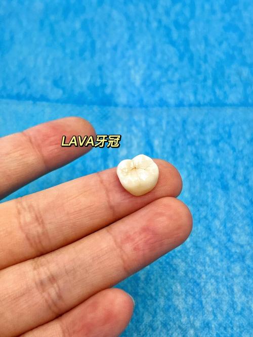 根管治疗后做牙冠正畸-图1