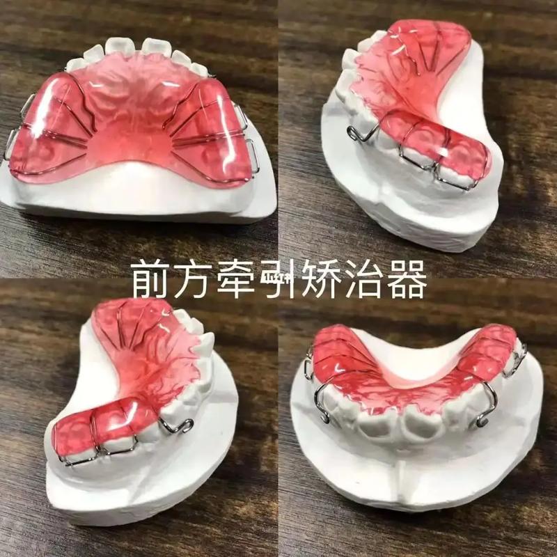 正畸前方牵引器图片展示了哪些佩戴和使用要点？-图1