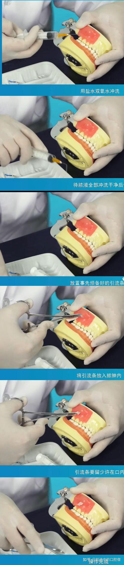 牙槽骨前突手术方法-图3