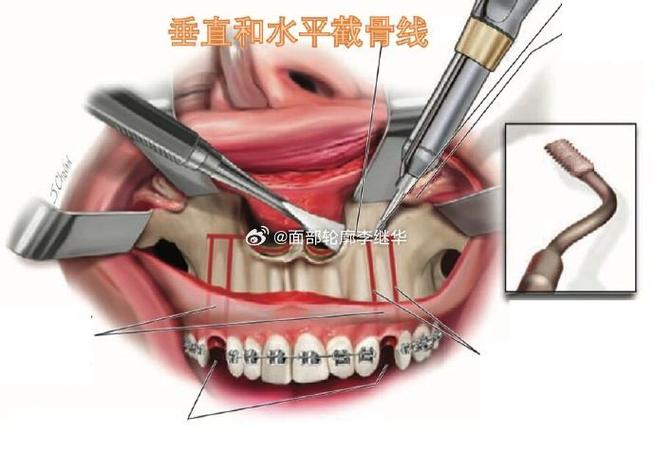 牙槽骨前突手术方法-图1