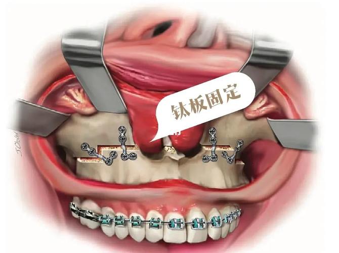 牙槽骨前突手术方法-图2