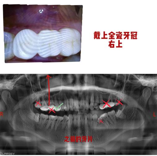 种牙后牙冠按装流程是怎样的？步骤、方法及注意事项解析-图2