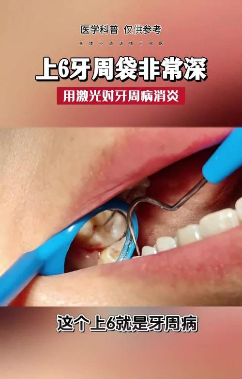 牙周纤维袋使用方法-图1 牙周纤维袋使用方法-图1