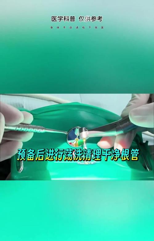 根管振荡仪使用方法-图2