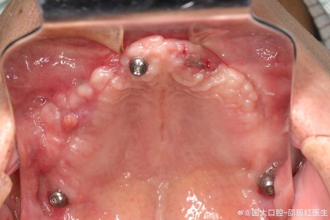 上额窦漏能种牙吗?风险与条件需知-图1 上额窦漏能种牙吗?风险与条件需知-图1