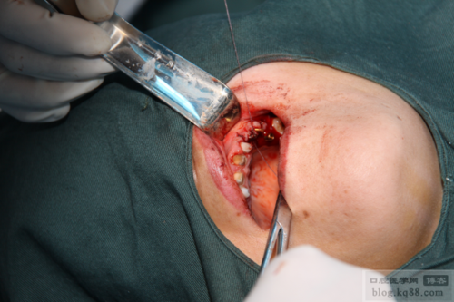 上额窦漏能种牙吗?风险与条件需知-图2 上额窦漏能种牙吗?风险与条件需知-图2