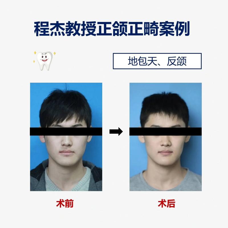 正颌手术矫正地包天,具体有哪些常用方法?哪种最有效且安全可靠呢?-图3 正颌手术矫正地包天,具体有哪些常用方法?哪种最有效且安全可靠呢?-图3