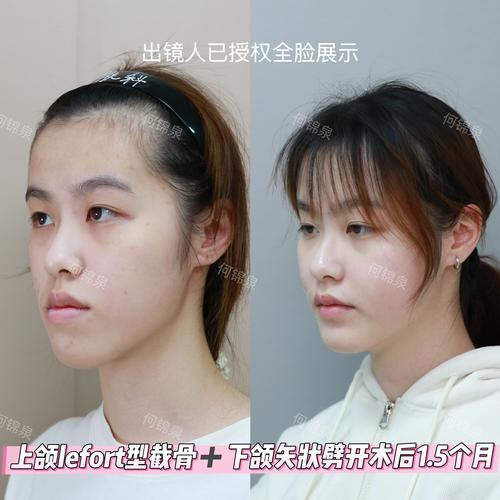 正颌手术矫正地包天，具体有哪些常用方法？哪种最有效且安全可靠呢？-图2