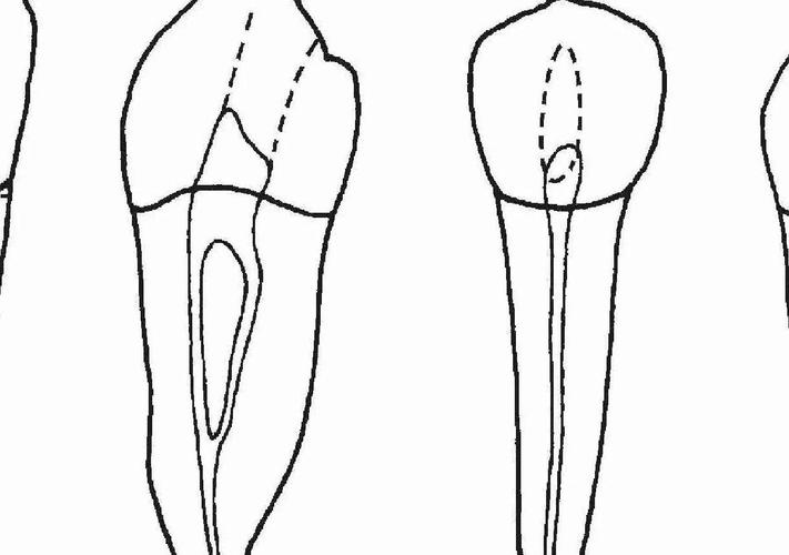 髓腔侧穿后,有哪些补救方法?-图1 髓腔侧穿后,有哪些补救方法?-图1