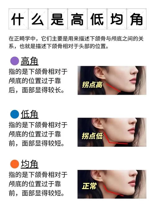 口腔正畸中u是指上颌还是下颌？求专业解答-图1