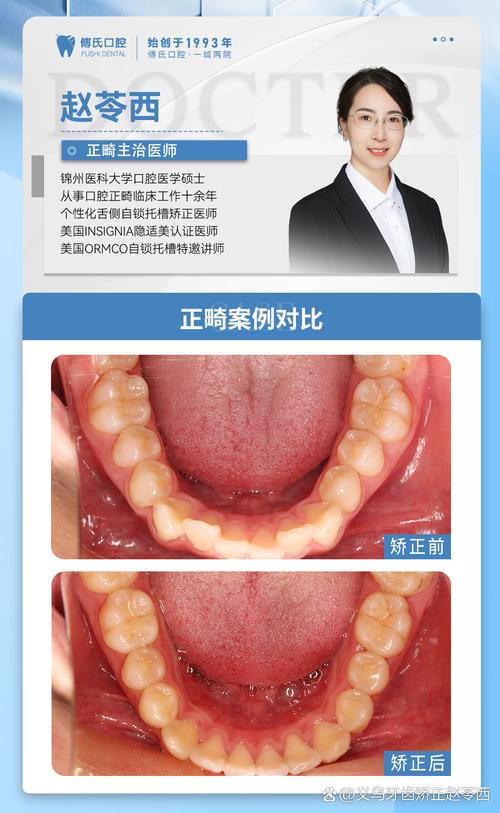 口腔正畸中u是指上颌还是下颌?求专业解答-图2 口腔正畸中u是指上颌还是下颌?求专业解答-图2