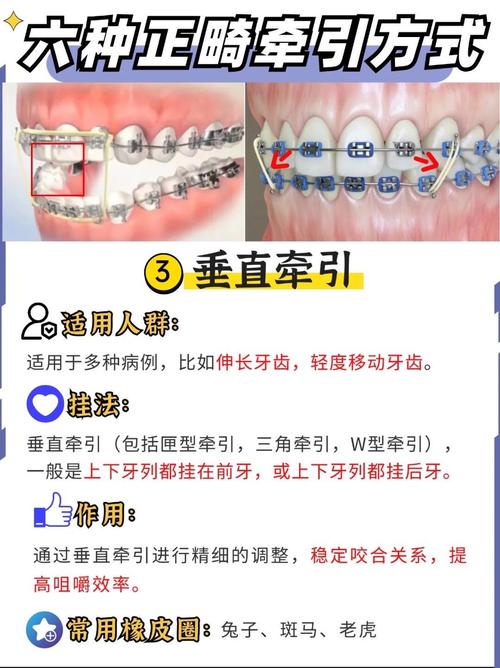 正畸牵引钩弯制方法-图1