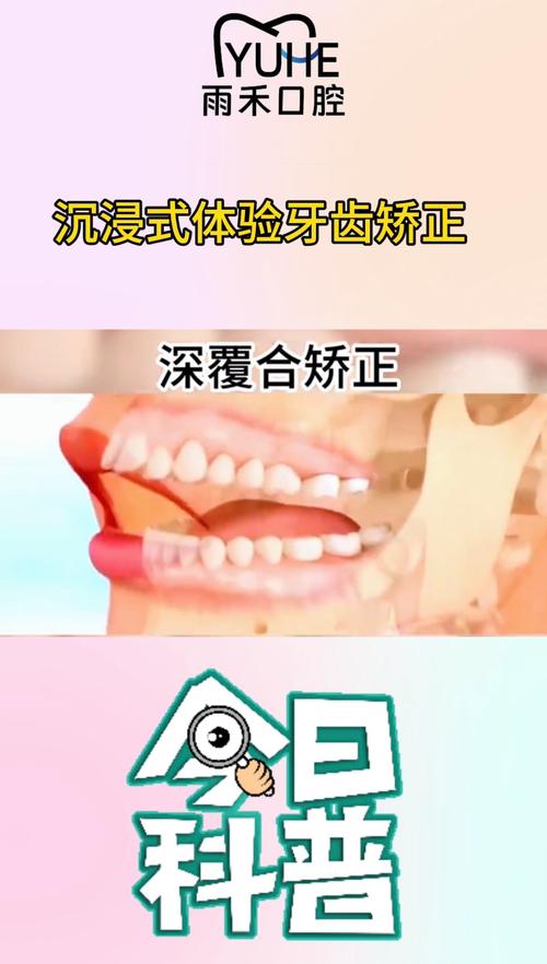 深覆合拔牙矫正方法有哪些？如何选择最合适方案？-图3
