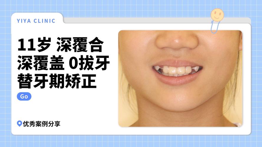 深覆合拔牙矫正方法有哪些？如何选择最合适方案？-图2