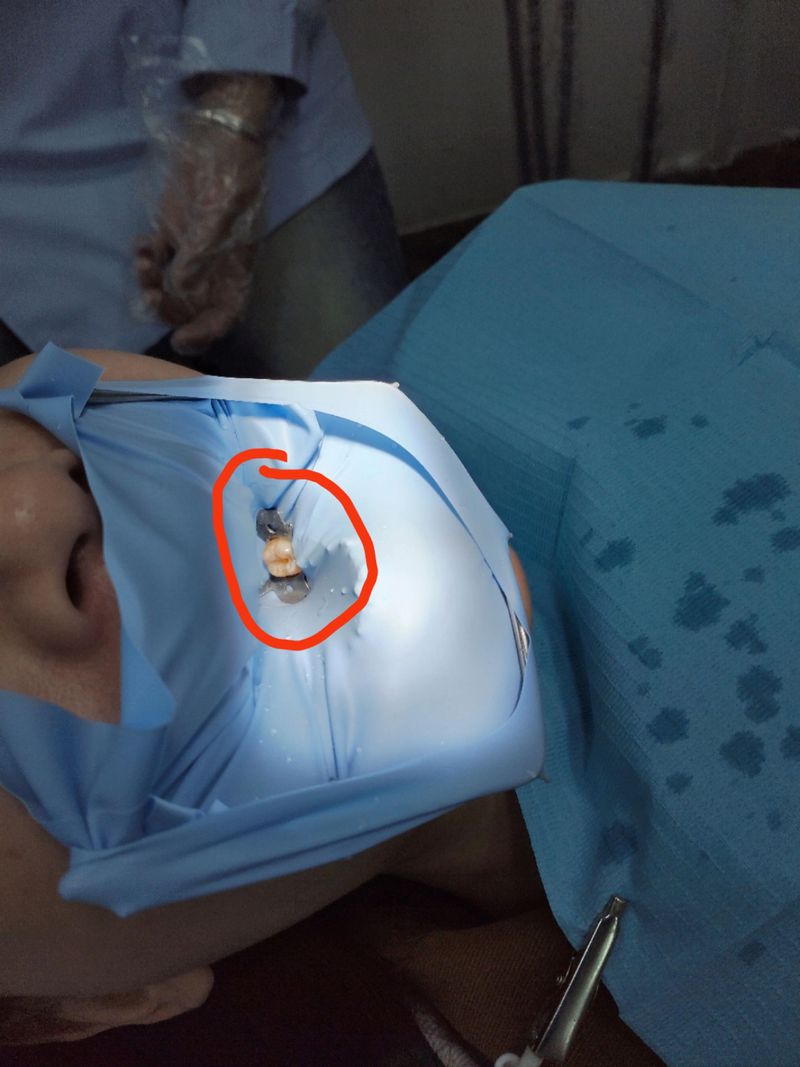 橡皮障使用方法视频-图3