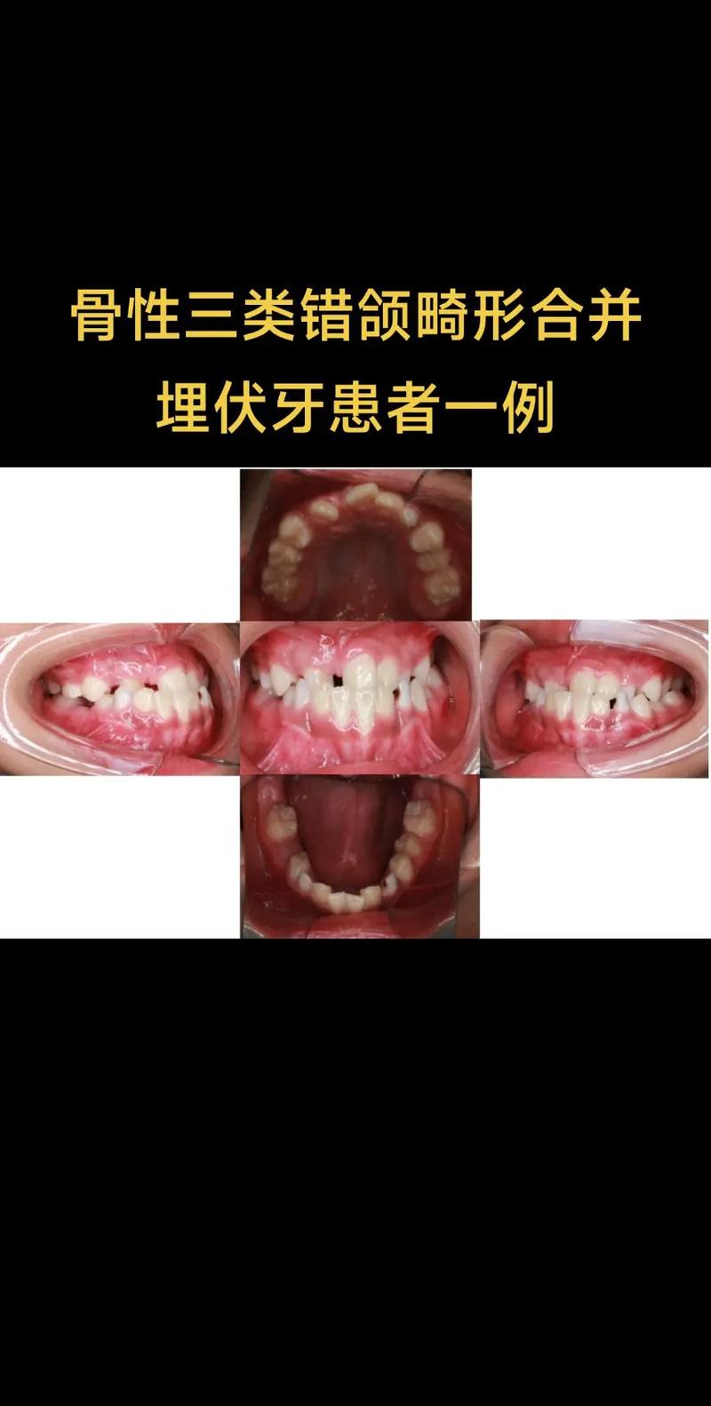 颌面畸形患者能顺利种牙吗?-图2 颌面畸形患者能顺利种牙吗?-图2