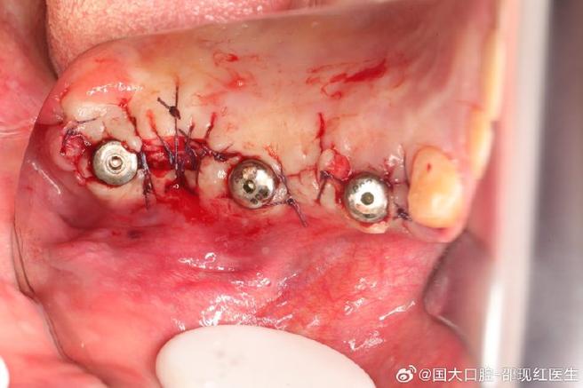 种牙手术后吃东西痛是什么原因?如何缓解?-图3 种牙手术后吃东西痛是什么原因?如何缓解?-图3