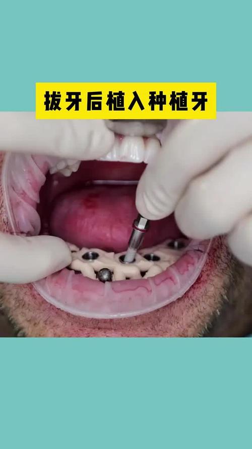 有牙医会自己种牙吗？亲身种牙的牙医多吗？他们为何选择自己动手？-图1