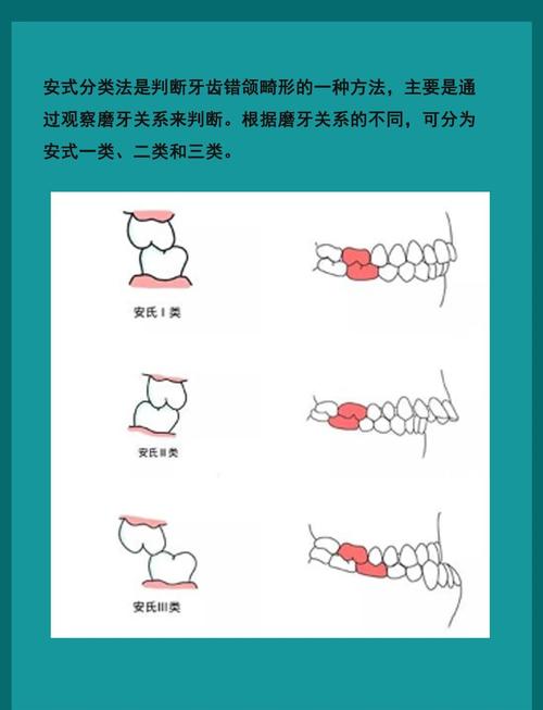口腔正畸远中牙合关系矫正的关键策略有哪些？-图1