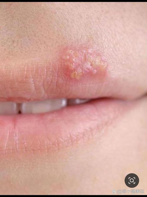 种完牙桩后嘴巴起泡-图3