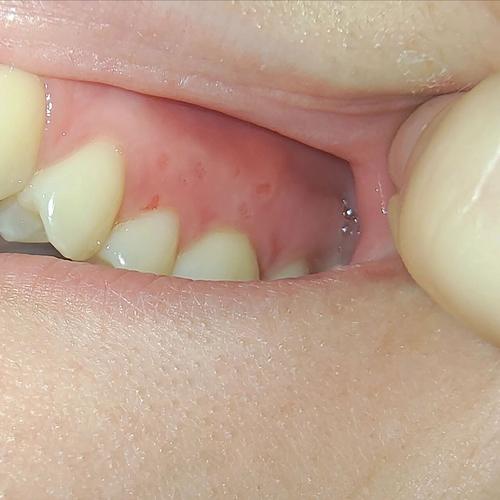 种完牙桩后嘴巴起泡-图1