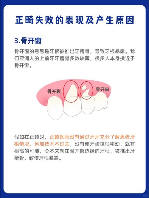 第一磨牙没了如何正畸-图1