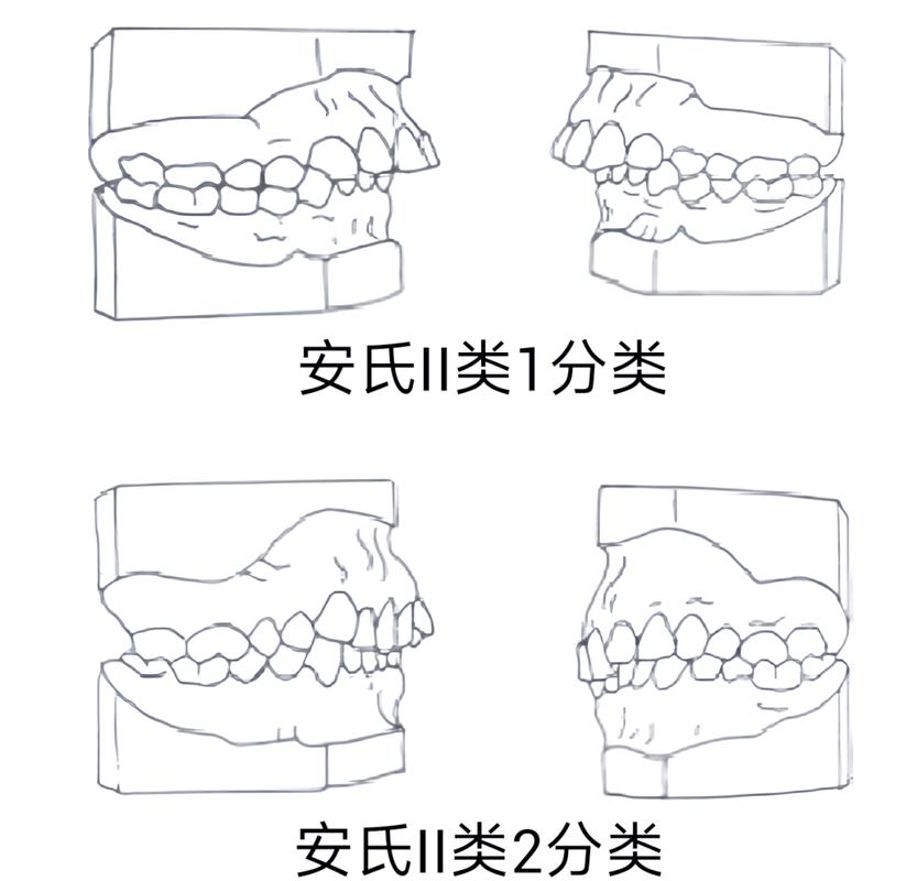 安式错颌的分类方法-图1