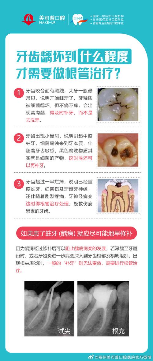 牙龋炎怎么治疗方法-图2