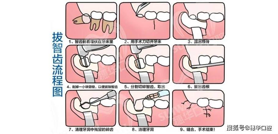 拔最后一颗智齿方法-图1