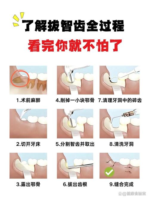 拔最后一颗智齿方法-图2