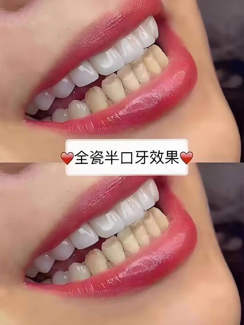 美国美白牙齿方法有哪些?主流方式有何不同?-图1 美国美白牙齿方法有哪些?主流方式有何不同?-图1