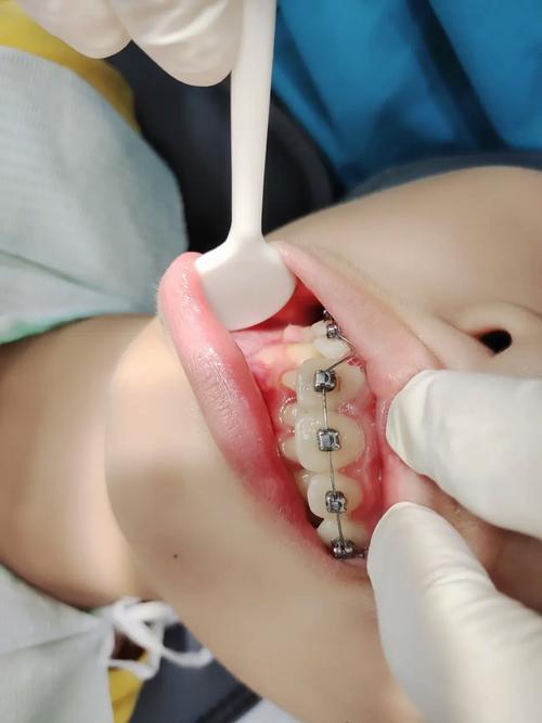 正畸自锁托槽粘接视频-图1