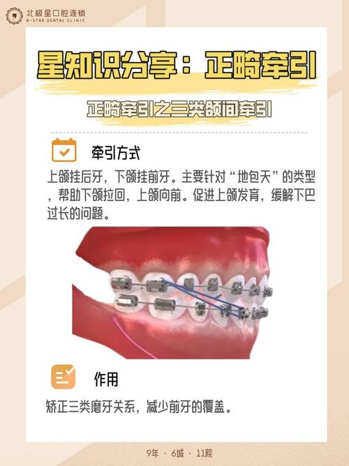 阻生齿能通过正畸牵引矫正吗?-图2 阻生齿能通过正畸牵引矫正吗?-图2