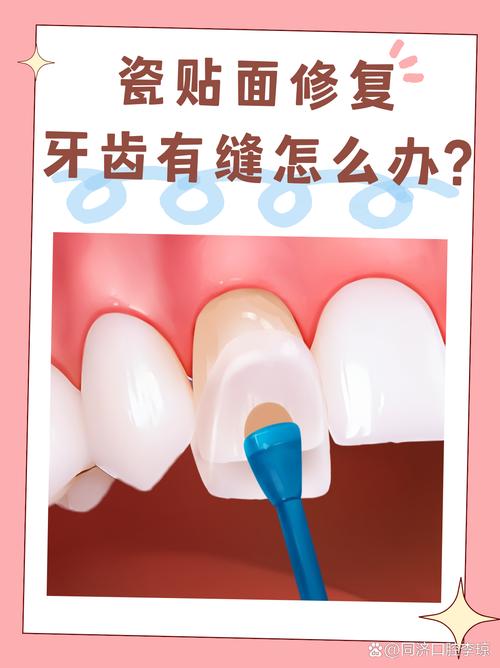 牙齿珐琅质修复方法-图1 牙齿珐琅质修复方法-图1