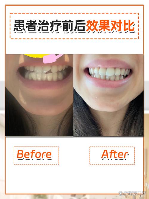 牙齿珐琅质修复方法-图3 牙齿珐琅质修复方法-图3