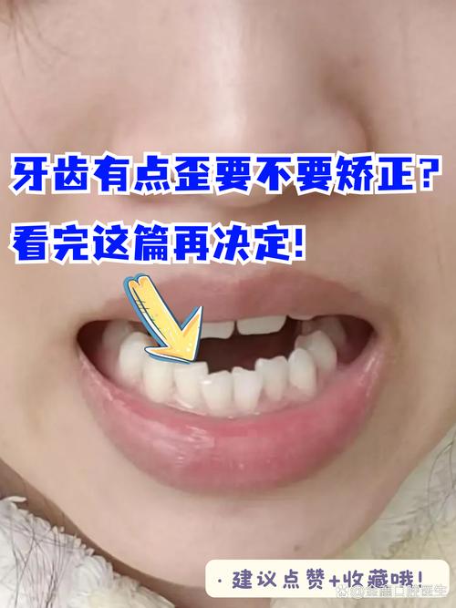 正畸下排牙齿向右倾斜是什么原因？-图2