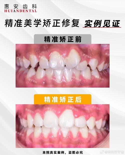 正畸下排牙齿向右倾斜是什么原因？-图1