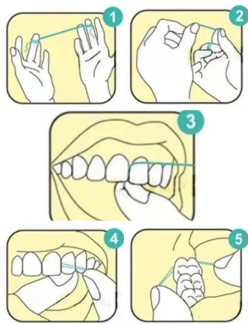 正畸时牙线怎么用？正确使用方法是什么？-图1