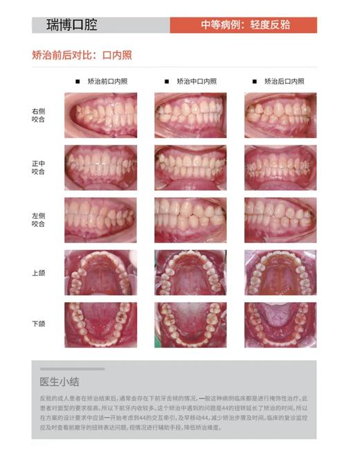 自己能改善反颌吗？有哪些实用方法可行？-图2