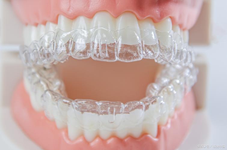 郑州3d数码隐形正畸-图2 郑州3d数码隐形正畸-图2