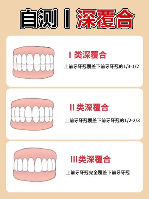 牙齿深覆合可以通过正畸矫正吗？-图3