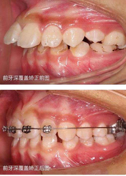 牙齿深覆合可以通过正畸矫正吗？-图2