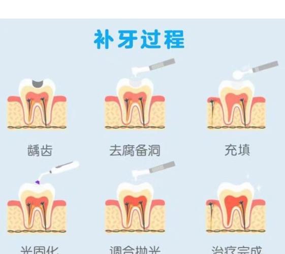 拔牙后补新牙的方法-图2