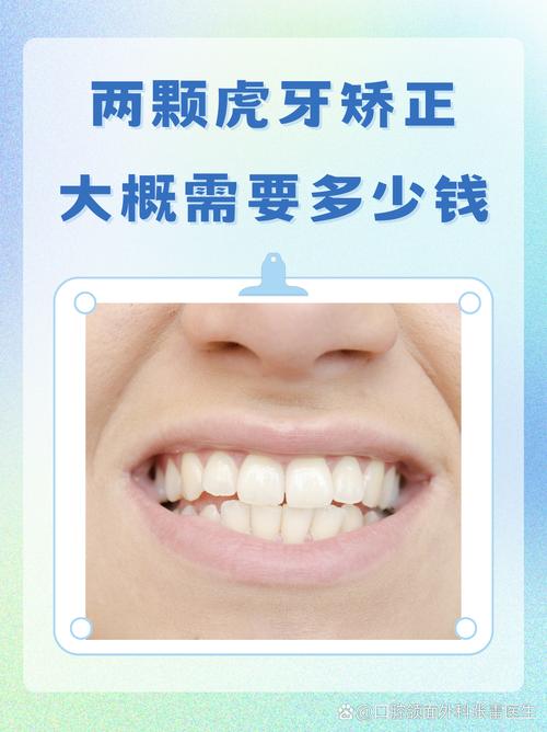 虎牙矫正方法有哪些?不同方法适合哪些情况?-图3 虎牙矫正方法有哪些?不同方法适合哪些情况?-图3