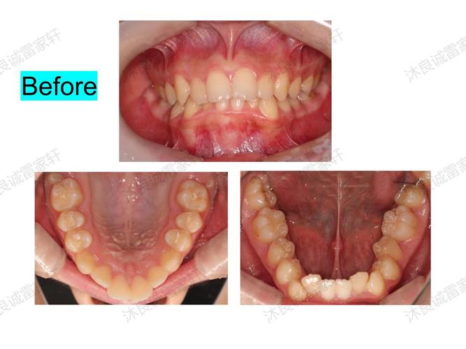 牙齿正畸扩弓真的能改变脸型吗?-图1 牙齿正畸扩弓真的能改变脸型吗?-图1